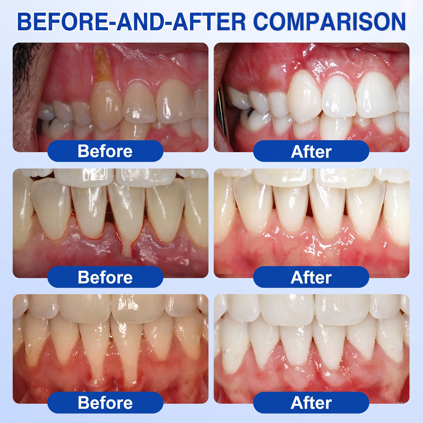 🇺🇸Pureluxo® 🦷GumRevive periodontal repair gel🌿