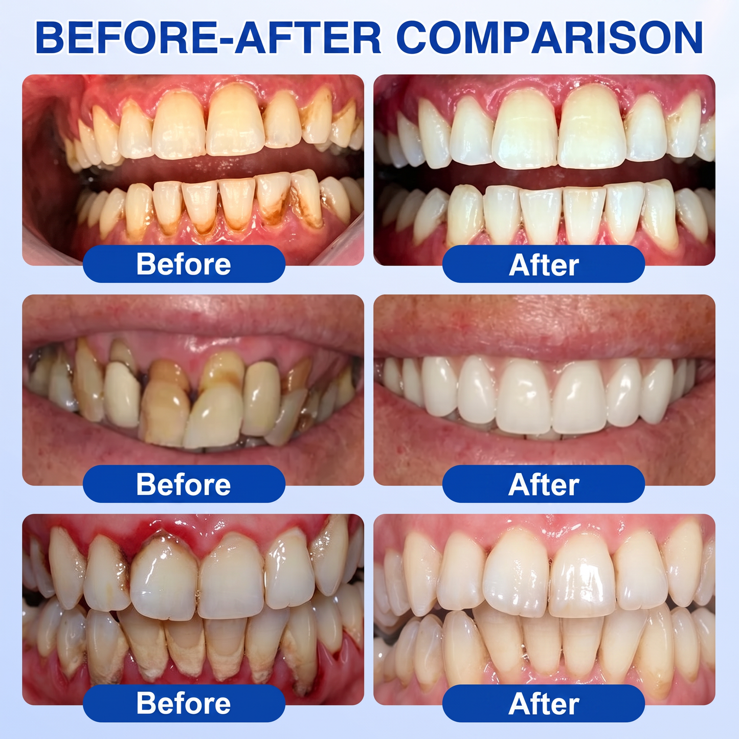 🇺🇸Pureluxo® 🦷GumRevive periodontal repair gel🌿